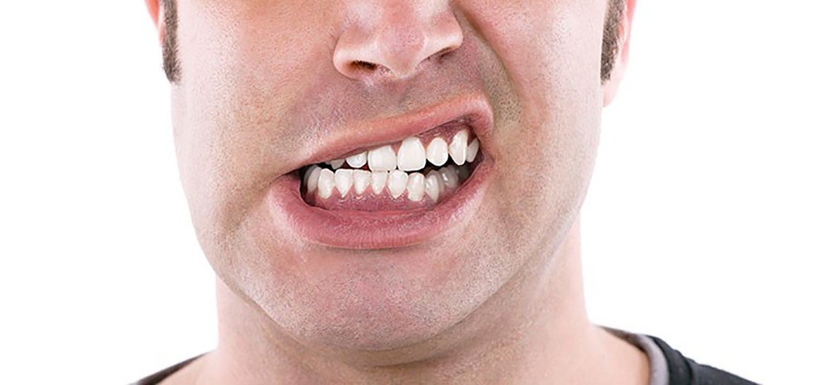 ndhicksville's tweet image. Maloclussion, or the incorrect placement of the teeth, can cause bite problems. #TipsND
