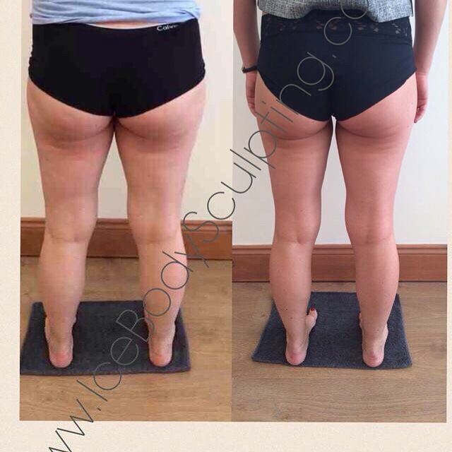 IceBodySculpt's tweet photo. Inner thigh reduction Single session required £310
#fatfreezing #inchloss #diet #weightloss #cardiff #cryolipolysis https://t.co/CsmJZl7RCl