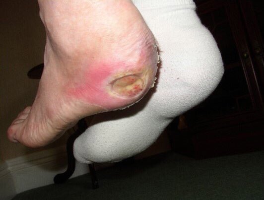 Coloplast_WCare's tweet photo. Did u know that #diabetes has a higher mortality rate than cancer &amp; AIDS combined and causes foot ulcers? #woundcare https://t.co/bTL1OWmuPz