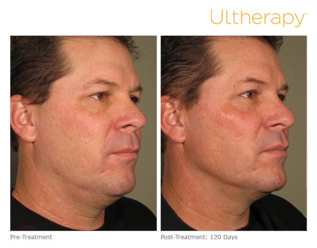 bb_lounge's tweet photo. #Ultherapy works great on #men too! Free consultation today! 619-692-9300 #medspa #menskincare #bbmls #sandiego #spa https://t.co/IoP0OHXEPx