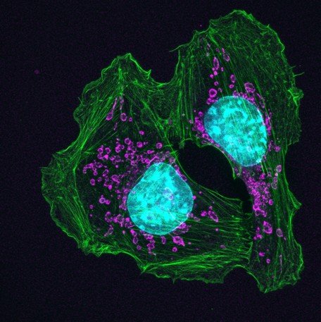 theNCI's tweet photo. How are cancer cells different from normal cells? In a variety of ways: https://t.co/XQ1RGVAajf #CancerCloseUp https://t.co/oEEw3d1T2B