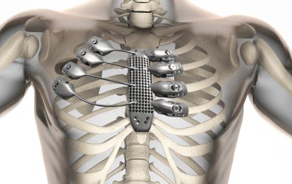 loohuaili's tweet image. #Cancer patient receives #3D printed ribs in world-first surgery ow.ly/r1vS303EDOJ @CSIROnews #healthcare #HIT