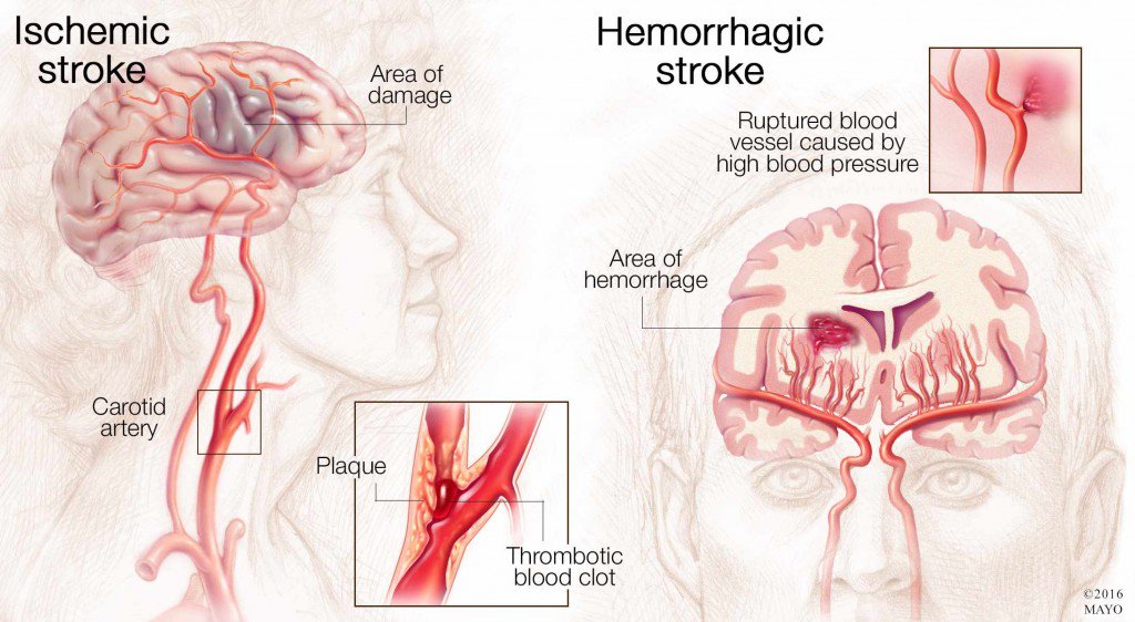 MayoClinic's tweet photo. Early treatment of #stroke can lessen or reverse the effects. Hear how from Dr. David Miller https://t.co/gnup0zZPOZ https://t.co/9yRoh9ZGQp