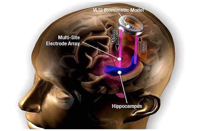 How kernel's brain prosthetic works