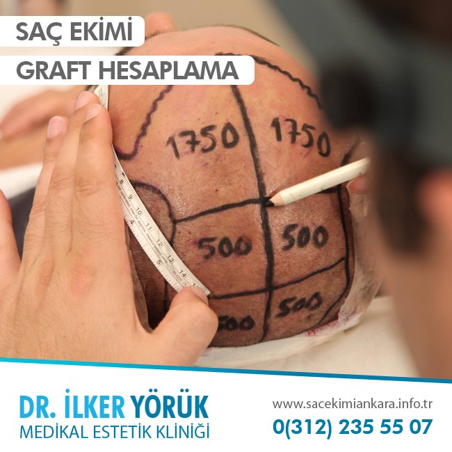 Saç ekimi graft hesaplama aracı ile ne kadar köke ihtiyacınız olduğunu öğrenebilirsiniz. bit.ly/2baHLX2