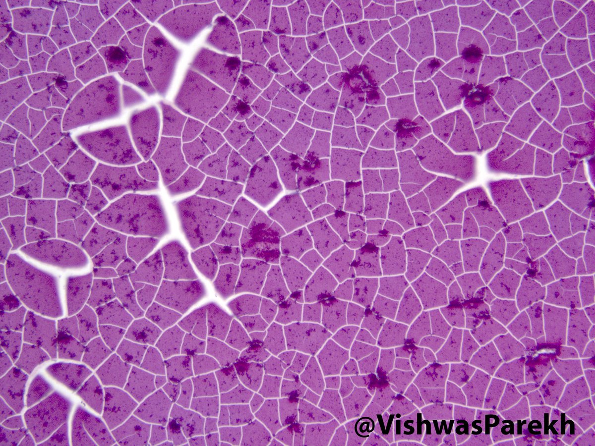 #Scrotal #Calcinosis | #PathArt #Pathology #Dermpath #BSTPath #Dermatopathology #Dermatology #PathBoards #DermBoards