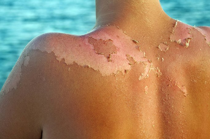 SkinCancerOrg's tweet photo. A  suppressed immune system makes skin vulnerable to sun damage that can lead to skin cancer https://t.co/ctreWVZmwE https://t.co/dolCljydwu