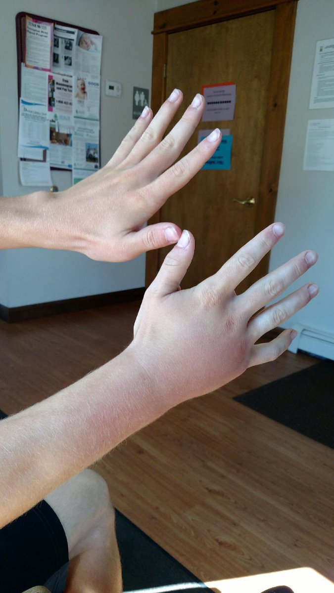 mal_krueger17's tweet photo. stung by a bee. Whoops https://t.co/9uGl65Yhg7