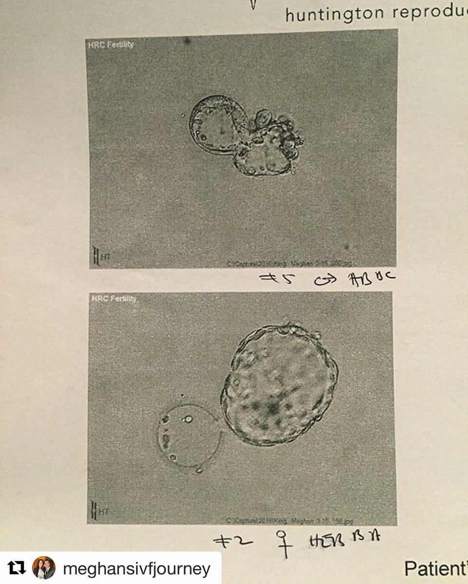 IVFGenderSelect's tweet image. Tune in to the @BravoRHOC tonight, to see Meghan King Edmonds embryo transfer at @HRCFertilityOC! #ivf #infertility