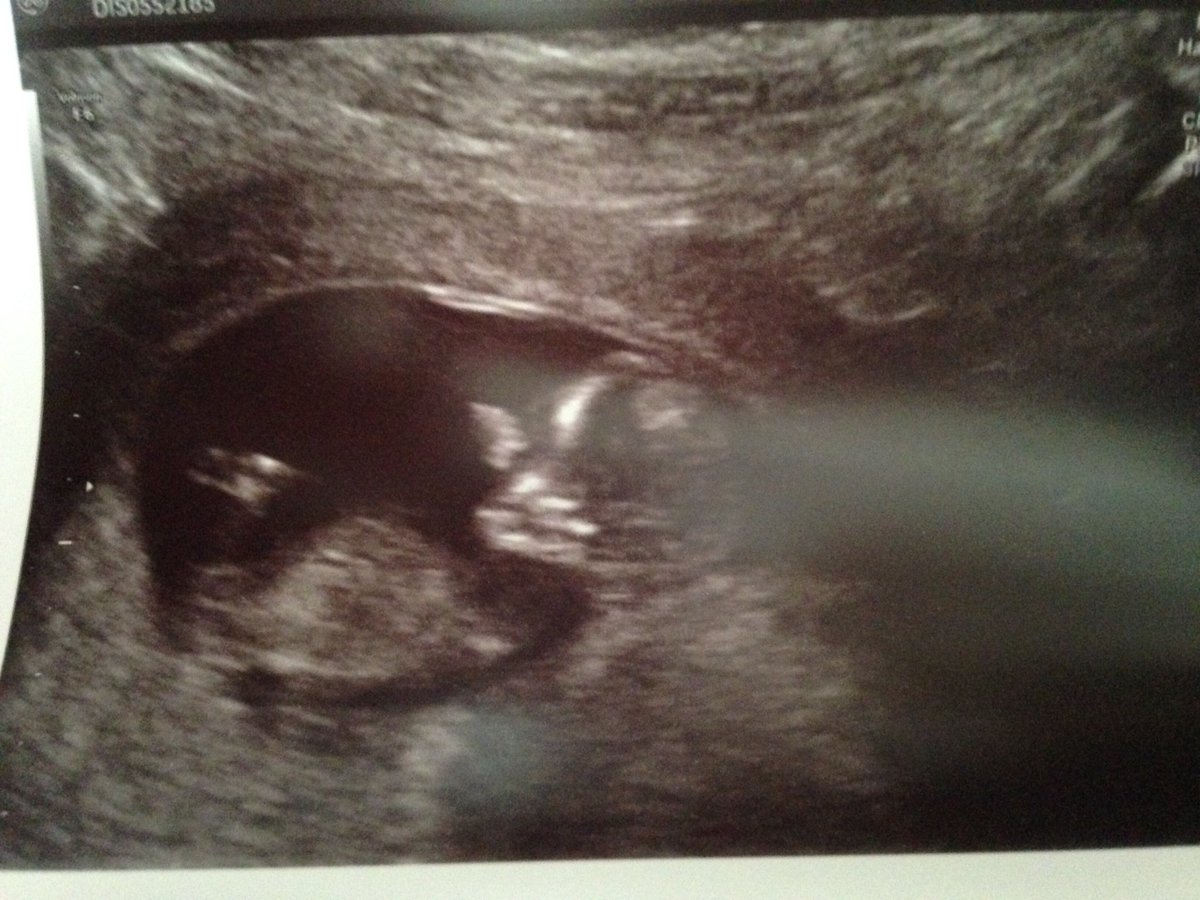 jessimp94's tweet photo. My little bean due in March ❤️ https://t.co/ZW5SntsC6Z