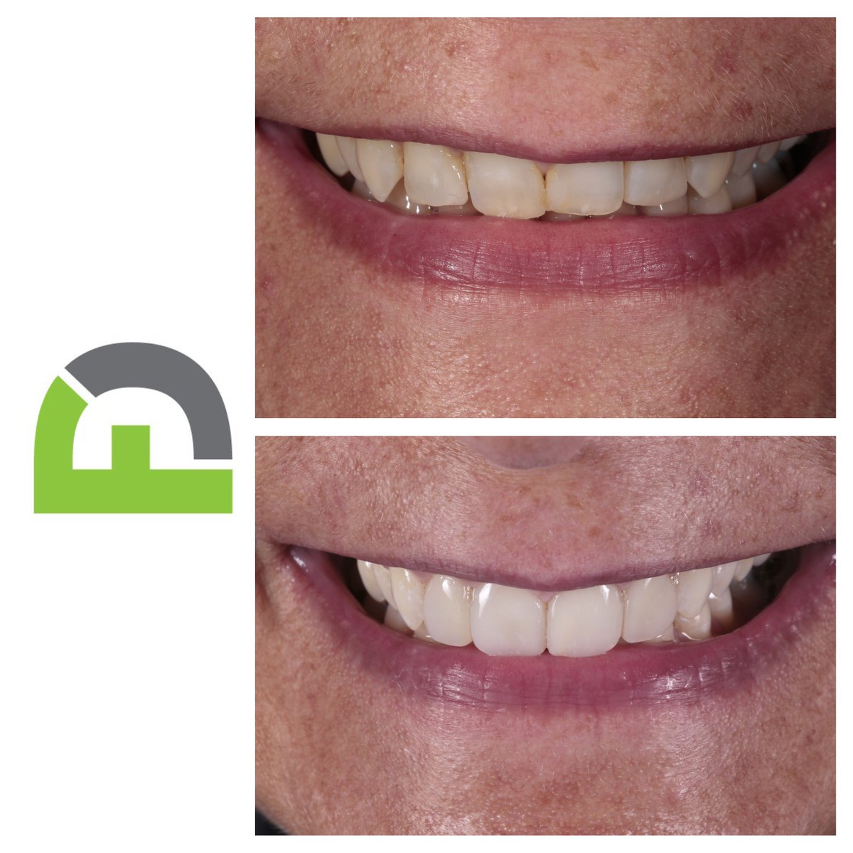 freshdentallond's tweet photo. Some naturally shaded composite bonding safely build up the worn down  front teeth #painless #nodrilling https://t.co/vwniHHiTcJ