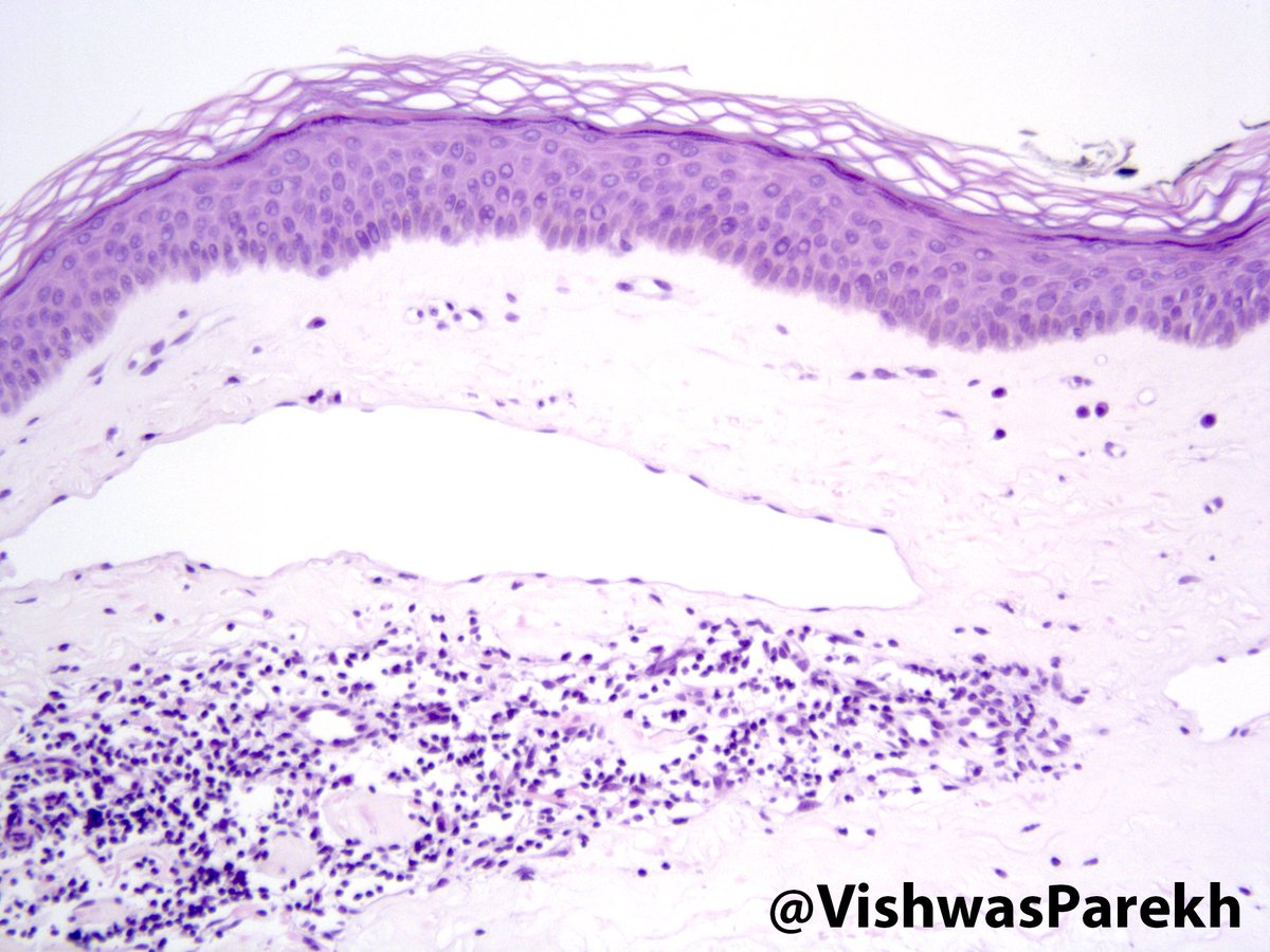Lichen Sclerosus et Atrophicus—Atrophic epithelium, Hyalinized dermis, Lymphoid infiltrate #RedWhiteBlue #DermPath