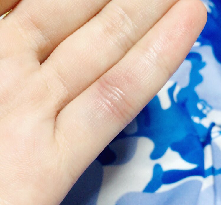 なつ氣 私この突き指して青くなるけどなんも処置しないっていうの0回くらい繰り返してるけどそろそろ指もげるんじゃないかな