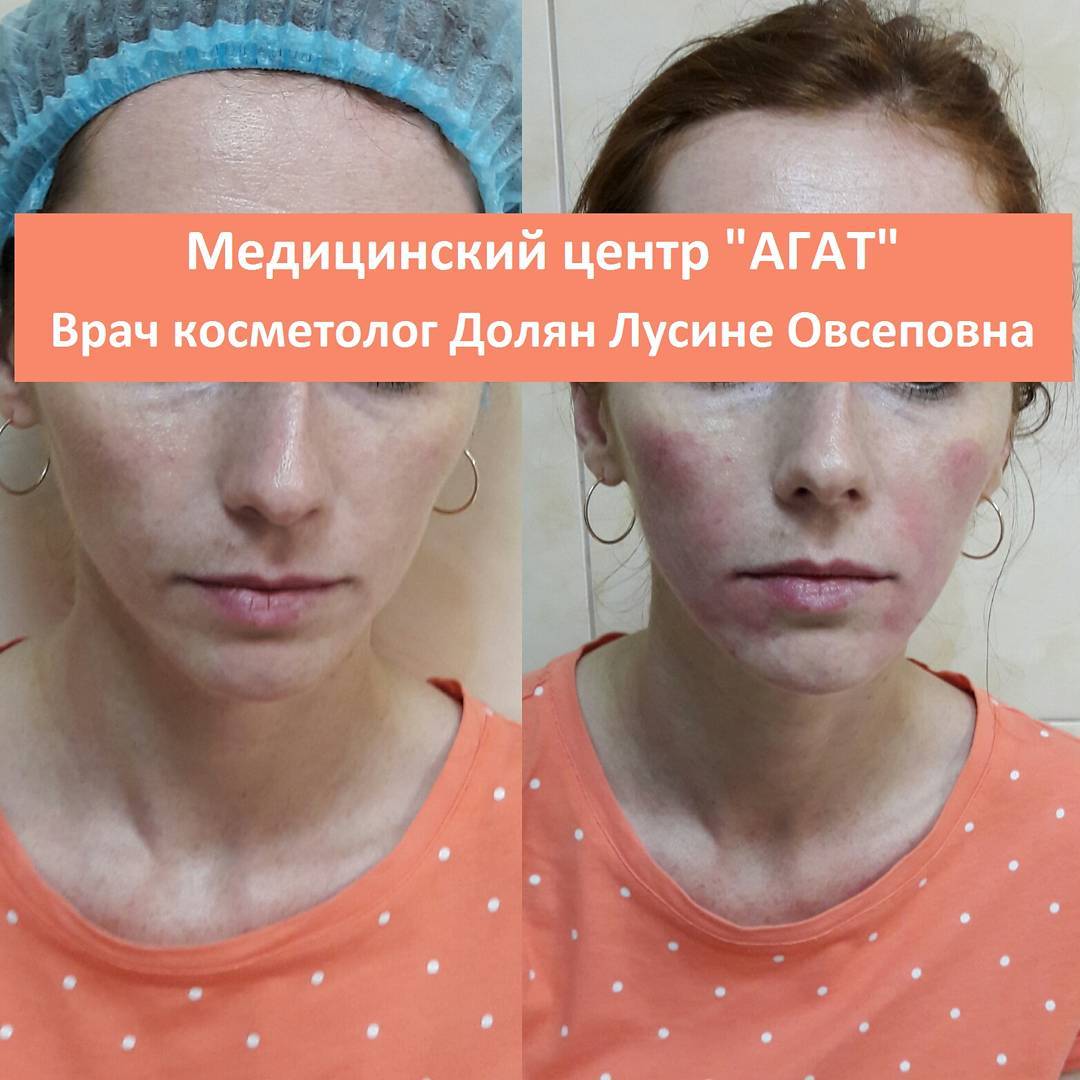 тредлифтинг мезонитями отзывы фото до и после