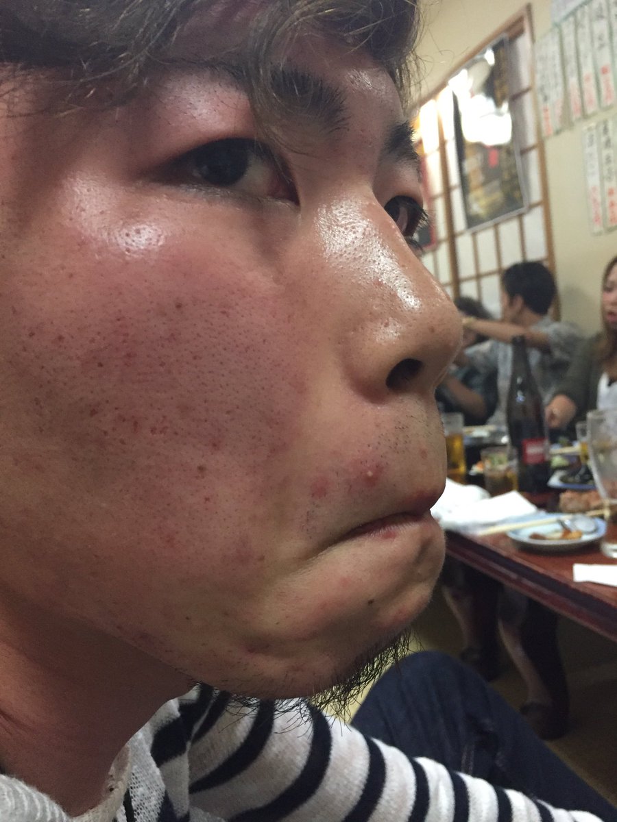 ট ইট র 東陽町 美容院 美容室 Index 佐藤かいくん 鼻の下に 笑 この年だとまだニキビと言うのでしょう 東陽町 美容師 イルミナカラー 若い時は ニキビと言う いつのまにか できもの ট ইট র 東陽町 美容院 美容室 Index 佐藤かいくん 鼻の下に 笑 この年だとまだニキビと言うのでしょう 東陽町 美容師 イルミナカラー 若い時は ニキビと言う いつのまにか できもの