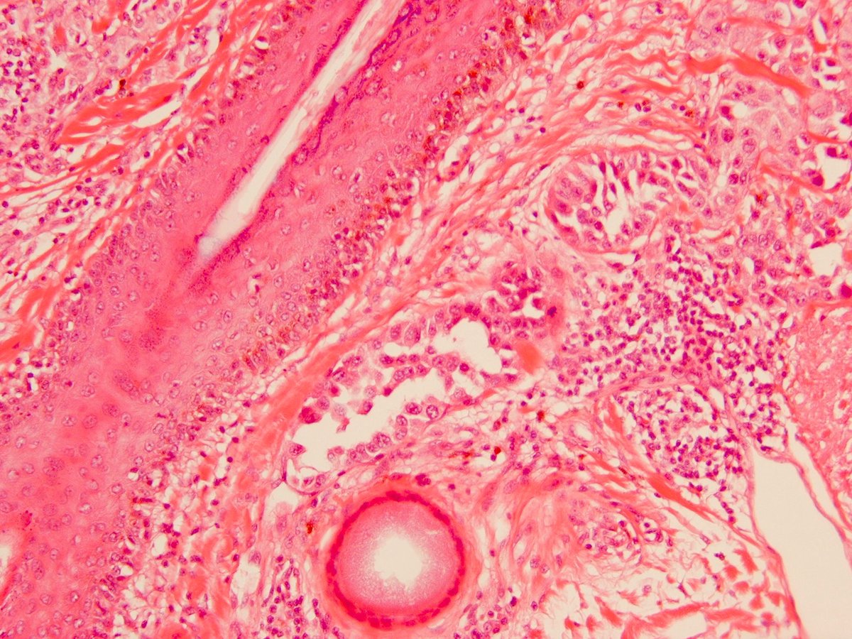 SkinPathology's tweet photo. #Melanoma with lymphovascular invasion (H+E and S100) #dermpath #dermatology #pathology #pathboards https://t.co/fTAzz1f0RM