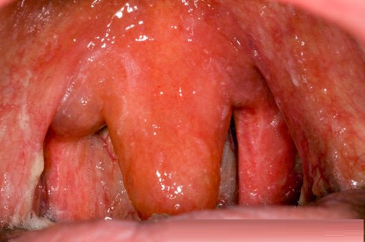 DiseasesList's tweet photo. #SwollenUvula #SwollenUvulacause, #Swollen #Uvula @ https://t.co/ZOyMBVxw99 https://t.co/9HdCYjI4jE