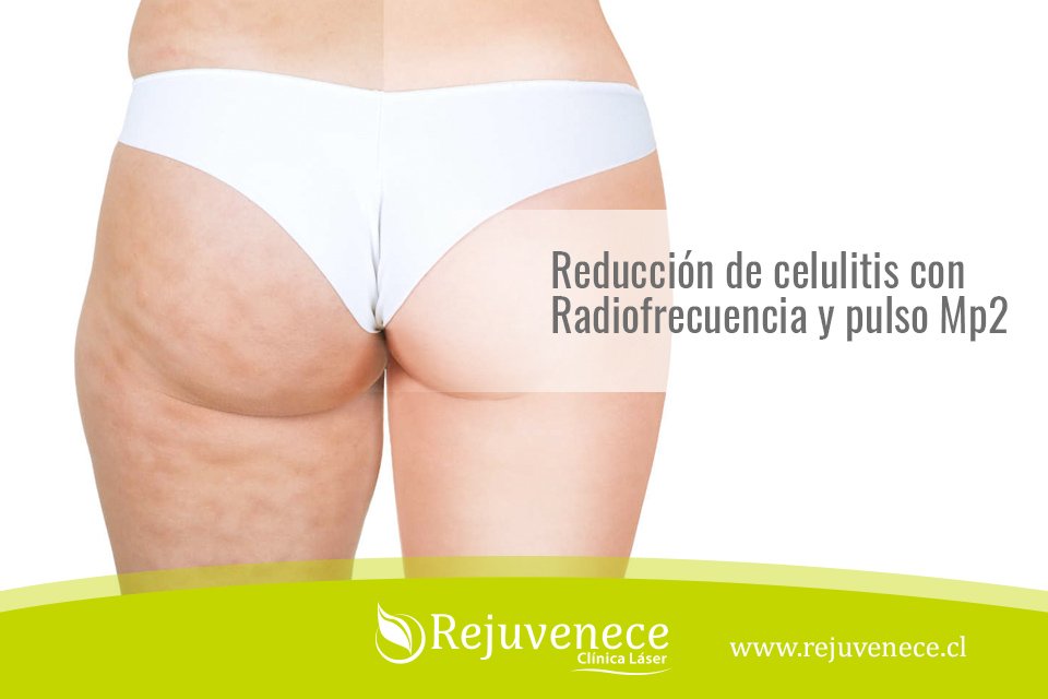 clrejuvenece's tweet photo. Les contamos que con Venus Freeze, podemos reducir de manera eficaz la molesta celulitis.
 https://t.co/Gp76Faqruo https://t.co/AlhIMlu3kq