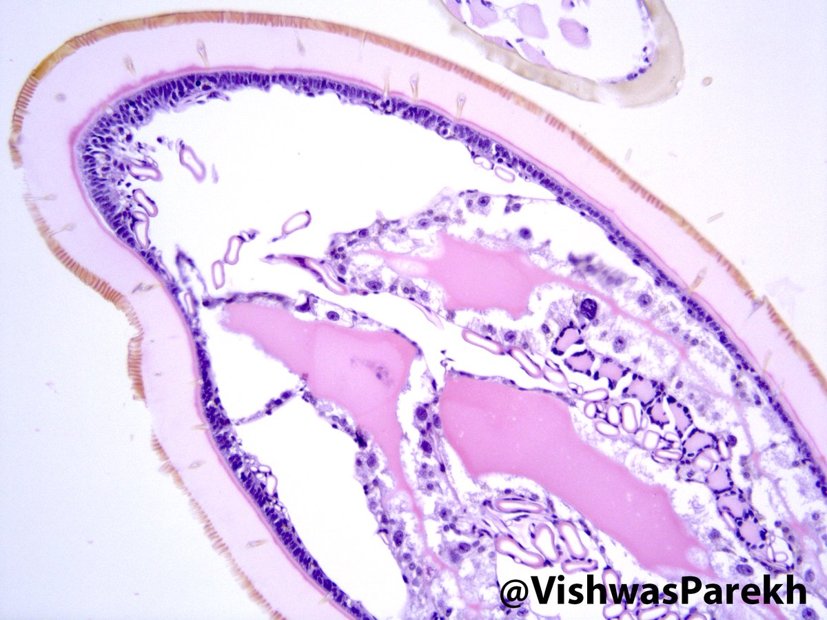 #Tick—Q fever #Tularemia #Lyme #Ehrlichiosis #Anaplamosis #Babesiosis #Powassan #STARI #DermPath #PathArt #Pathology