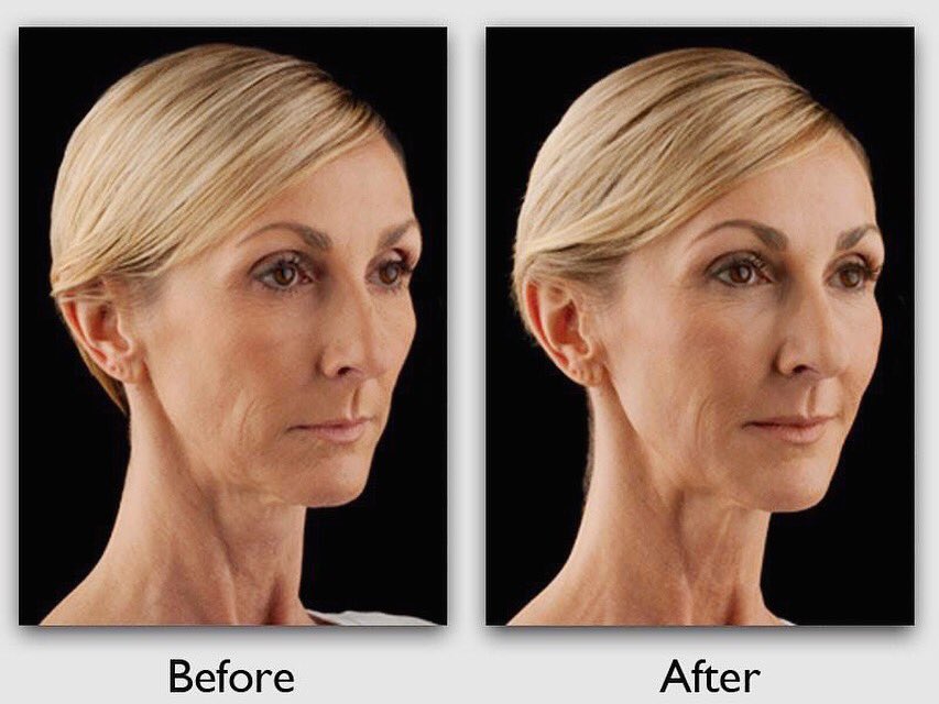 ShethDerm's tweet image. Voluma XC gives a natural looking lift &amp;amp; is a Non-surgical treatment with long results! #shethdermatology #youthful