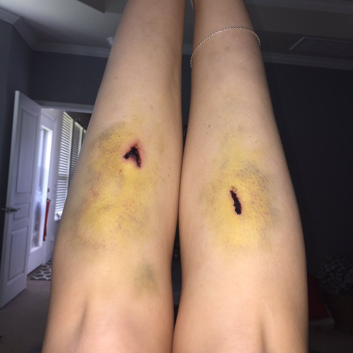 mfrasier86's tweet photo. @alispagnola here's my box jump fail from this summer... https://t.co/cicmLoPHij