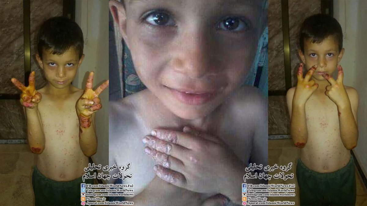 A7_Mirza's tweet photo. This #Syria-n kid from Foah &amp; Kafraya suffers from a skin disease &amp; cannot be cured because of siege by terrorists https://t.co/yhTrdoiGsG