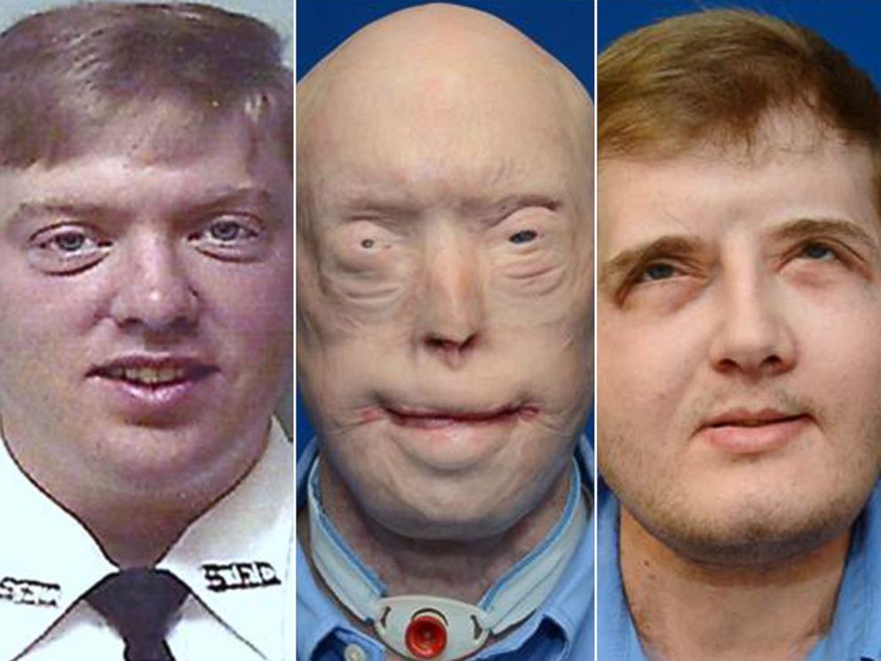 Year after undergoing most extensive face transplant ever performed