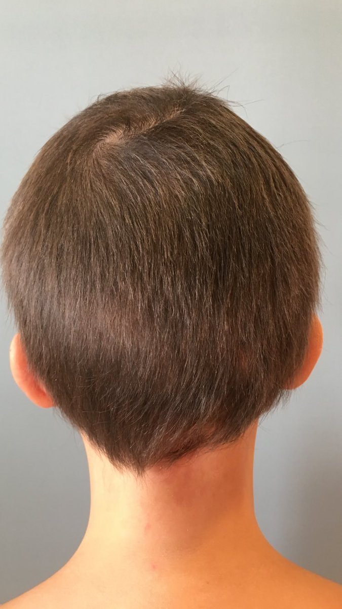SergioVanoG's tweet photo. Satisfecho hoy por ver esta evolución de una #AlopeciaAreata tratada con #difenciprona. #Tricología #Dermatologia https://t.co/acJuGdeiBk