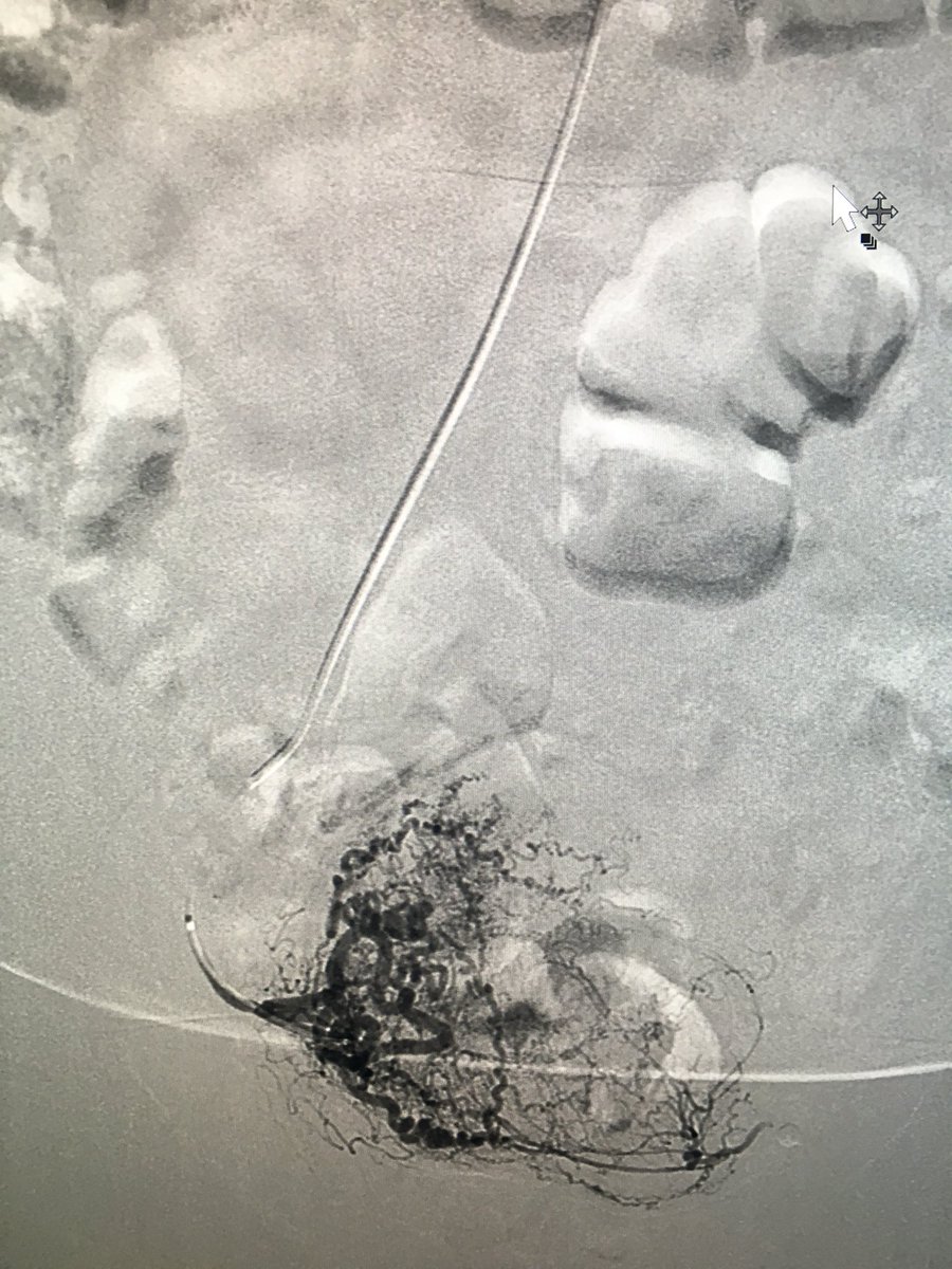 Preferring radial approach now for UAE. #irad #radialaccess #radialfirst @MUSCVIR @Drshiloh @JVIRmedia @uab_ir