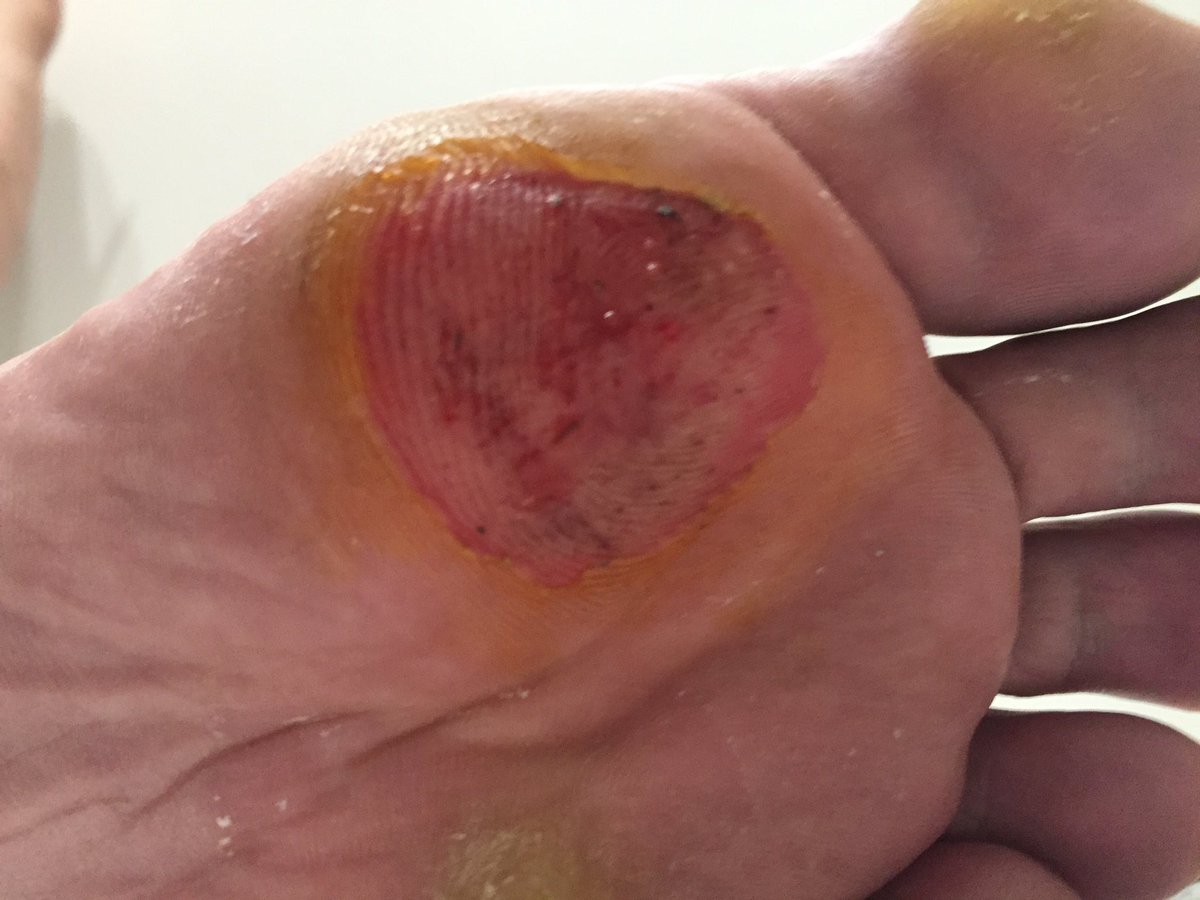 No todo son alegrias,entrenar fuerte tiene sus riesgos