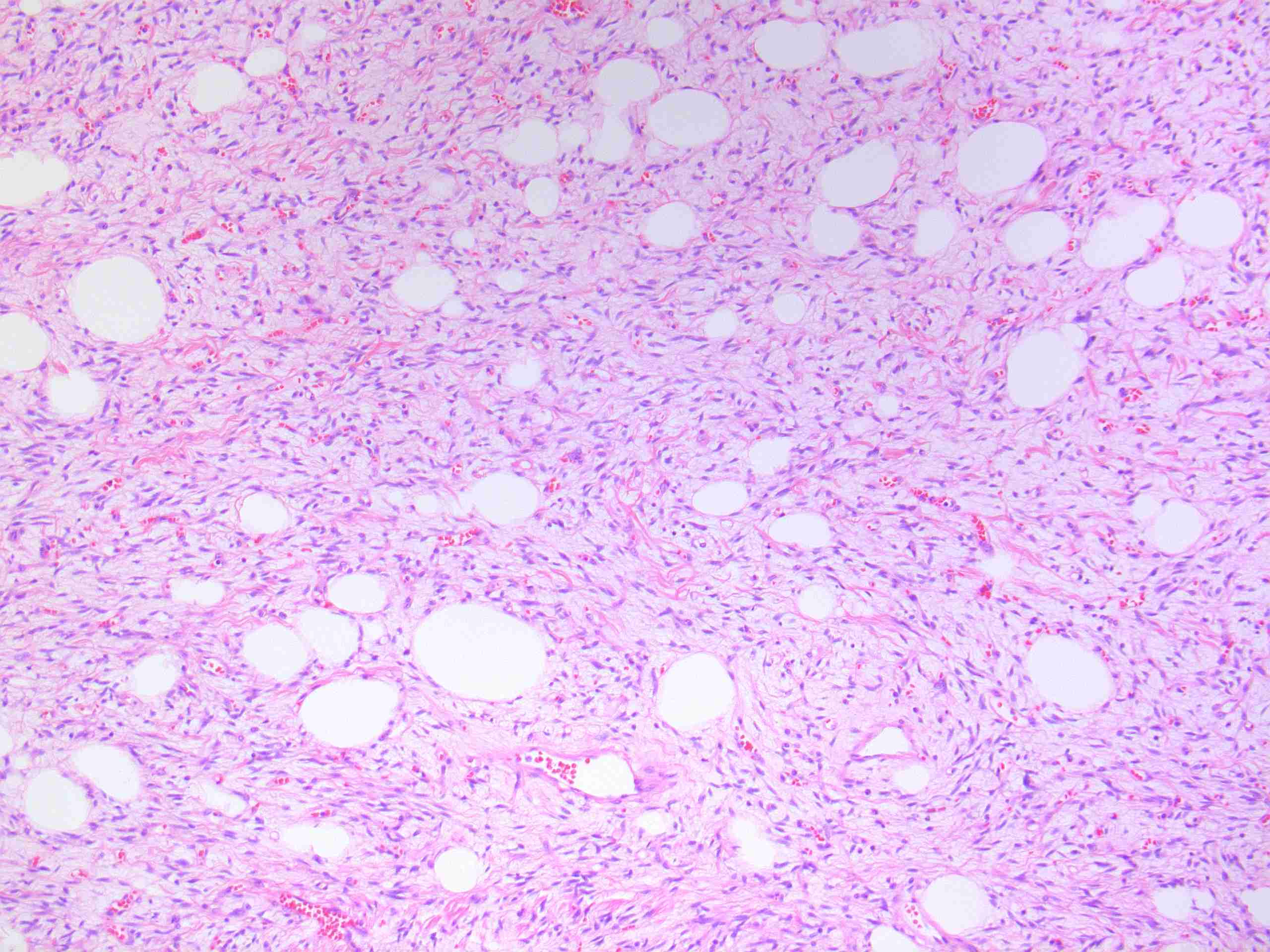 spindle cells and ropey collagen- found in spindle cell lipomas