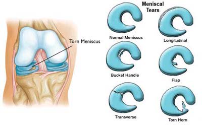 sportsurgeonng's tweet image. Meniscus tear....A common yet often underdiagnosed cause of knee pain in adults usually less than 40years old.