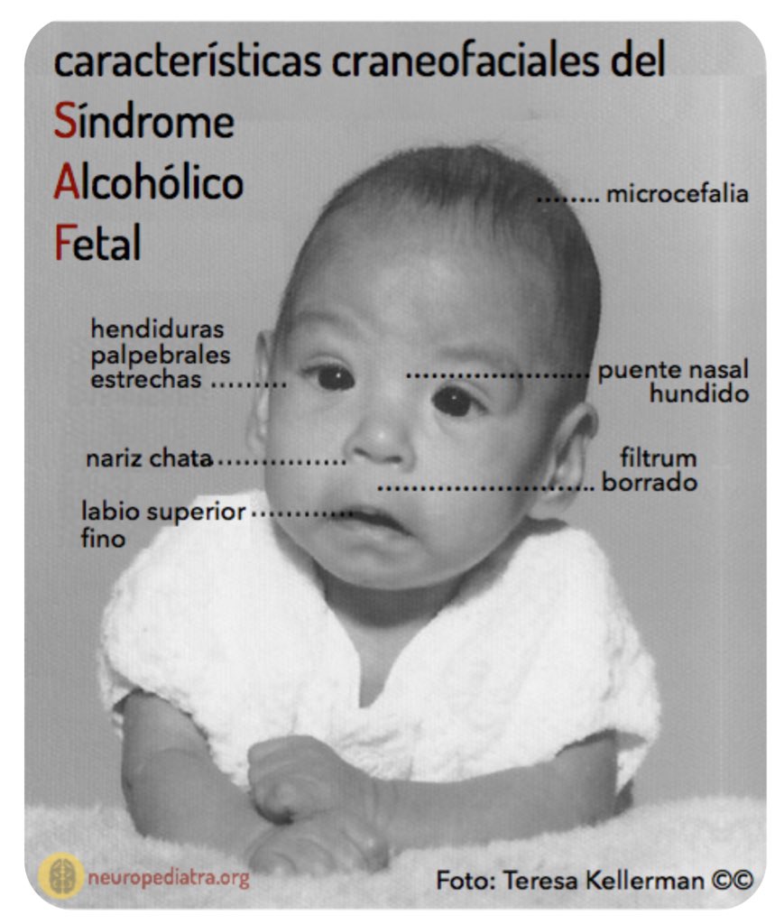 NoInvisibles's tweet photo. Hoy Día del Síndrome Alcohólico Fetal
#DiaMundialSAF
Es 💯❌💯 evitable!
https://t.co/ETW1TjtMu3
Gracias @MasTwitts
#fb https://t.co/FyA1hzefA7