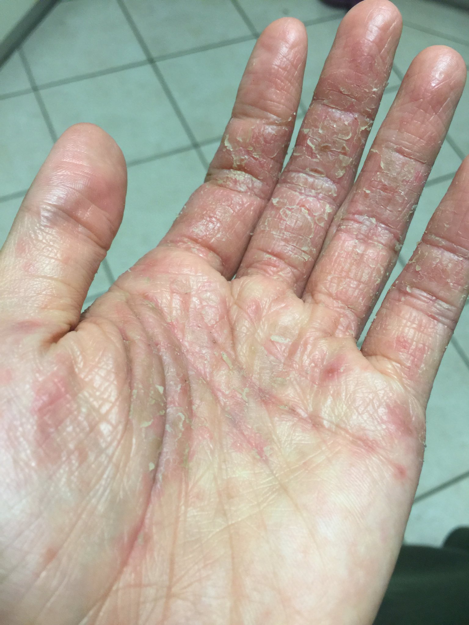 手湿疹 アトピー 皮膚炎と戦うブログ 先日のお仕事おわり 皮剥けと乾燥は気になるけど 腫れてない 熱を持っていないだけでだいぶ楽 決まって痒くなる夜中の2時におびえながら就寝 手湿疹