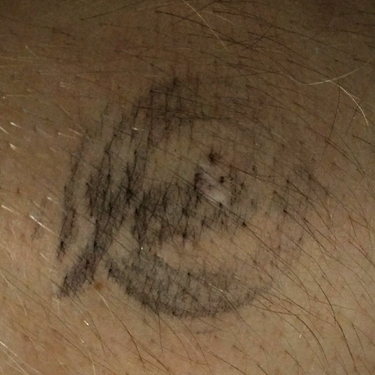 ardavey's tweet photo. Still branded from last night's encounter with @YetisComedy. Great show! #TeamSteve https://t.co/bVDdvG4hZa