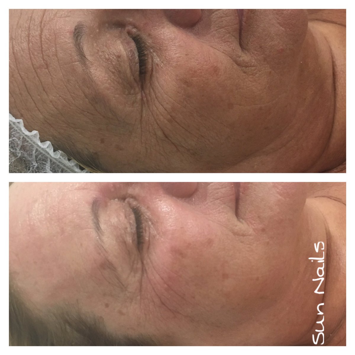 esteticSunNails's tweet photo. Seguimos con resultados increíbles con #dermiasolution @skinfaktor https://t.co/2GpNpg59sO