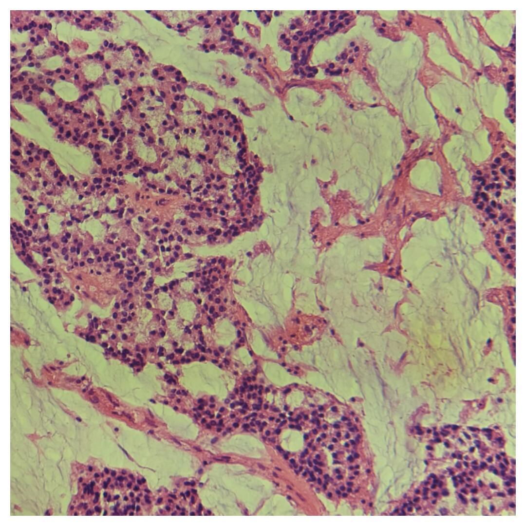 fahdrefai's tweet photo. Abundant extracellular mucin and prominent intracellular mucin with signet-ring cell morphology. https://t.co/qvS8R3XfTA
