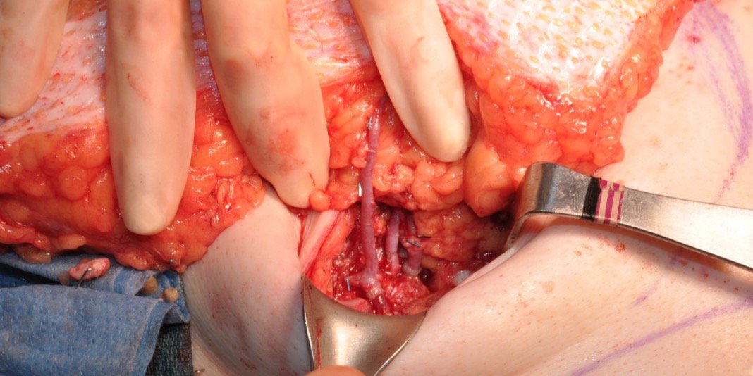 danielzliu's tweet photo. Double venous system drainage in #DIEPflap #BreastReconstruction https://t.co/Ub96KBPoOW #MicroSurgery #Protip https://t.co/3IQcwKmSwF