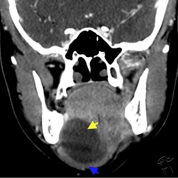 кт околоушной слюнной железы. опухоли слюнной железы кт. образование подчелюстной слюнной железы кт. аденома околоушной железы кт. киста подчелюстной железы мрт.