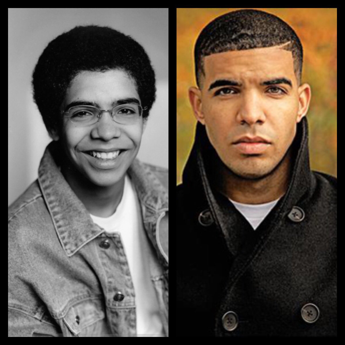 Drake Nose Job