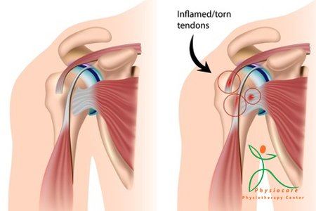 The rotator cuff muscles stabilize the shoulder literally like a cuff. goo.gl/niY0PJ #PhysiotherapyDubai