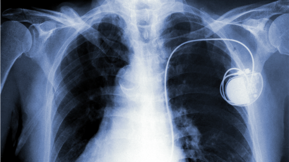 kimkomando's tweet photo. #Pacemaker #hacking fears rise based on critical research #shockingstudy #hackersstrikeagain
https://t.co/msSPaNsVLQ https://t.co/B66WssE8rN