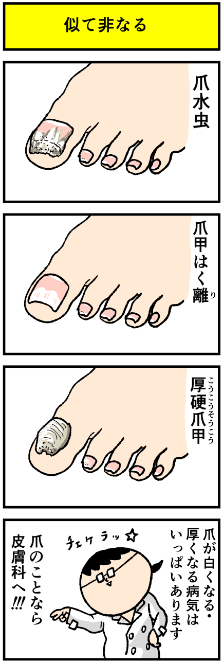 デルぽん デルマな日常 爪が白い病気は爪水虫 他にもあるよ T Co Ke0hwyxg T Co U8a1ayusrj Twitter