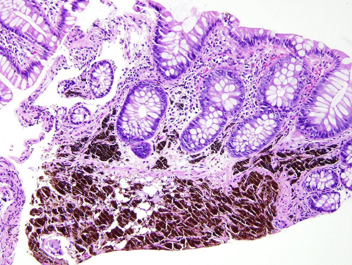 ARP_Press's tweet photo. Blue nevi of the colorectum are rare but have appearances like those of cutaneous examples. https://t.co/Uu8QV9Petx https://t.co/veGwcTxSPR