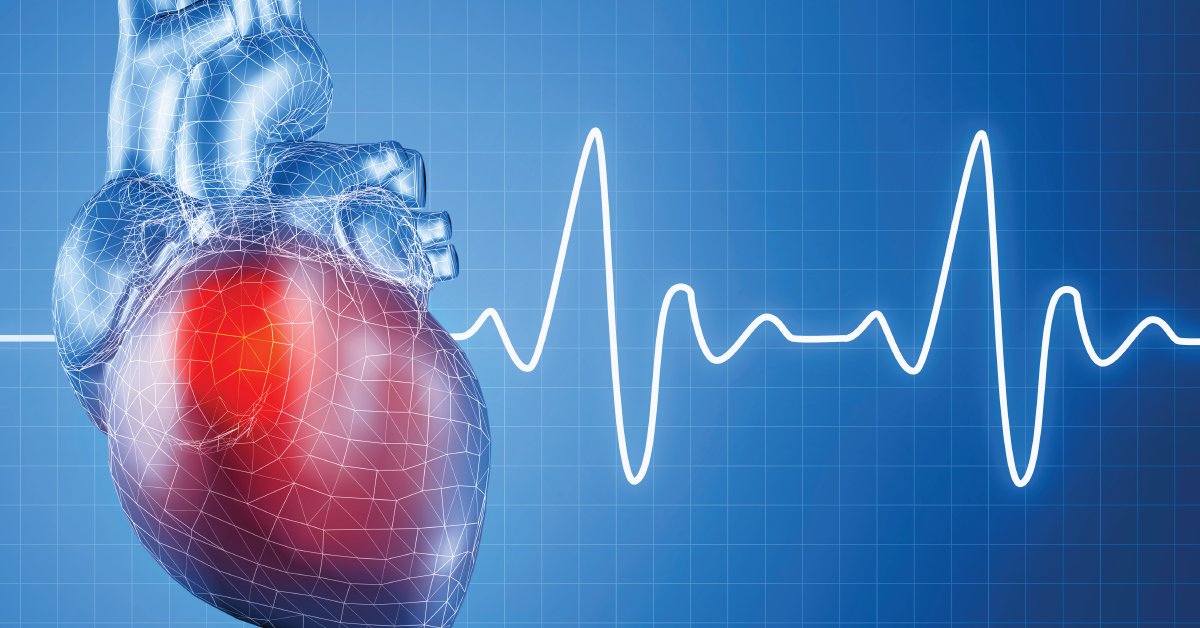 Learn more about the signs and symptoms of atrial fibrillation, or irregular heartbeat. wb.md/2bSxFuR