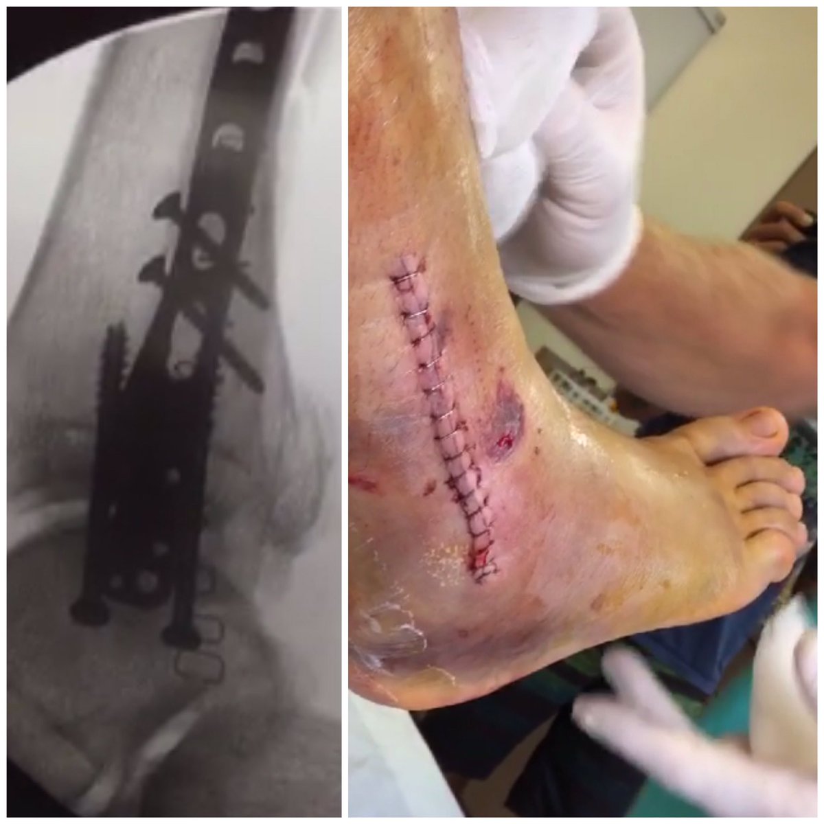 I made it through the crucial first 24 hours after surgery with just Advil and Tylenol, smooth sailing from here!