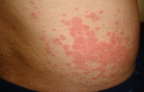 DiseasesList's tweet photo. #Maculopapular #Rash #MaculopapularRash #MaculopapularRashpictures @ https://t.co/NNf1J23TA7 https://t.co/iUK6GMbXzh