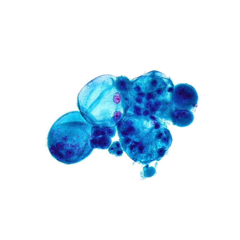 A cluster of #multi-nucleated #malignant cells found in the same #pleuralfluid as the last… ift.tt/2caog0E