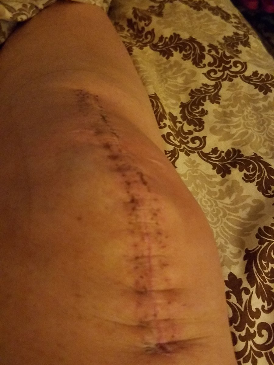 backthebadgebbq's tweet photo. Healing good. Please pray. Thanks. https://t.co/CAYdPevyPJ