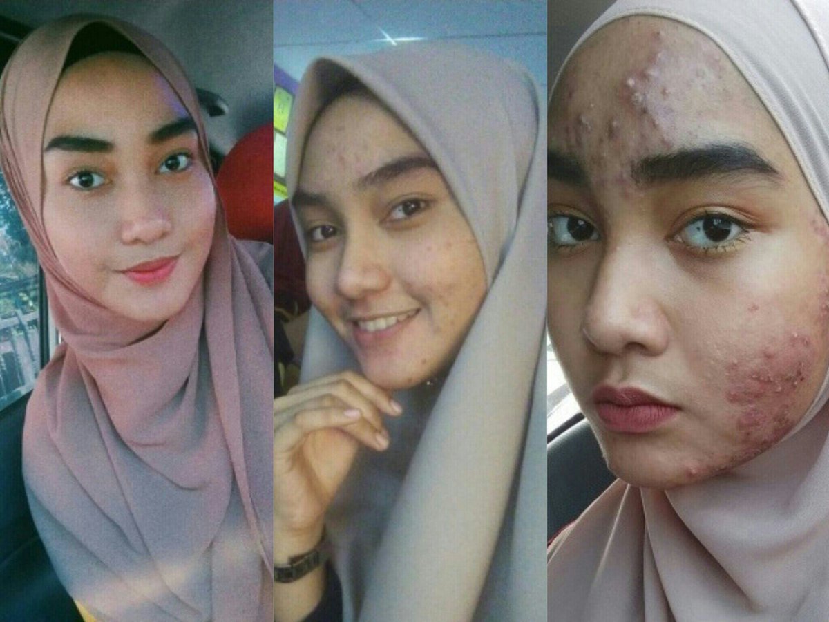 Buat Para Wanita: Hati-Hati Wajah Bisa Rusak Parah Karena Facial - AnekaNews.top